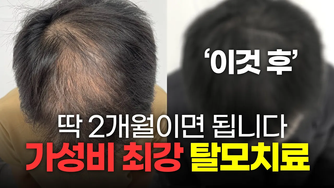 정수리탈모 2개월 만에 효과 보는 가성비 시술ㅣ뉴헤어