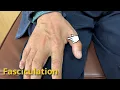 Fasciculation ALS