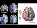 Anomic Aphasia