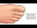 How To Soften Thick Toenails