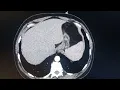 Download Lagu CT Renal angio
