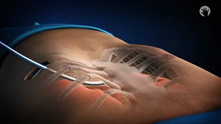 Modified Nuss Procedure For Pectus Excavatum 
