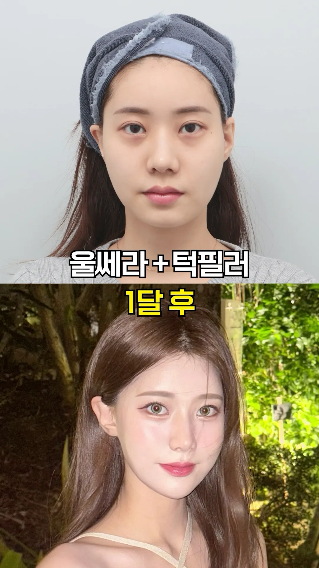 울쎄라+턱필러 1달 후