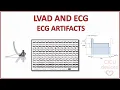 LVAD AND ECG - UNDERSTANDING ECG ARTIFACTS AND HOW TO MINIMIZE THEM