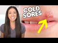 What are COLD SORES How To Get Rid of Them