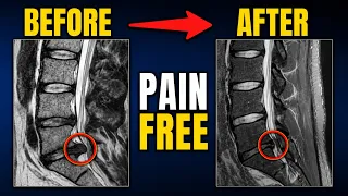 L5 S1 Disc Herniation Before-and-After MRI Shows Reabsorption