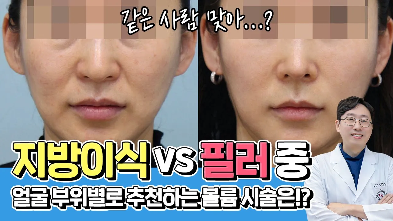 얼굴 볼륨시술엔 지방이식? 필러? 부위 별로 추천해드림!🙌 feat. 보정 어플 쓰면 이래서 예뻐 보이네!