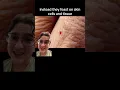 Did you know chiggers can really pack a bite