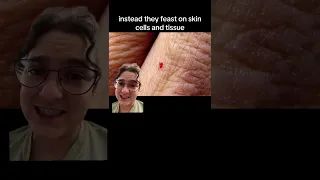 Did you know chiggers can really pack a bite