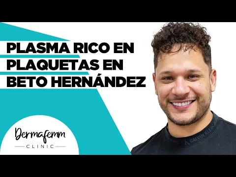 Download MP3 APLICACIÓN DE PLASMA RICO EN PLAQUETAS EN BETO HERNÁNDEZ - En zona facial, cuello, manos y capilar