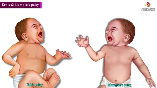 Erb s Palsy and Klumpke s Palsy Animated