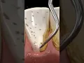 Download Lagu cleaning teeth with ultrasonic scaler #shorts #dentist #teethcleaning
