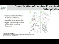 Indirect Decompression The Risk Within the Remedy