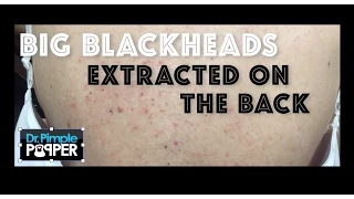 Download Re-introduction to Big Blackheads on the Back MP3