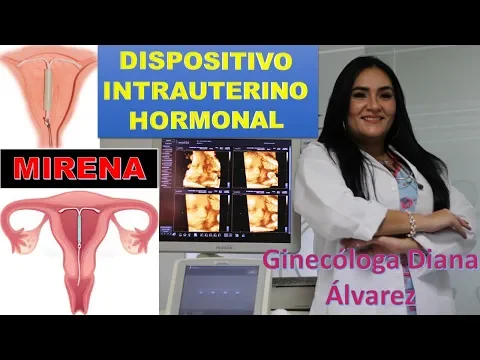 Download MP3 DISPOSITIVO INTRAUTERINO HORMONAL, por GINECOLOGA DIANA ALVAREZ