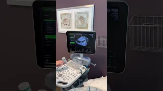 FINDING OUT WERE HAVING TWINS
