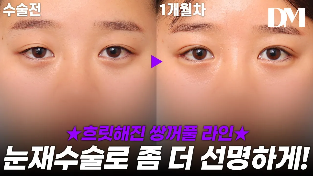선명한 썽꺼풀 라인으로 또렷해진 눈!! #눈성형 #코성형 #뒷트임