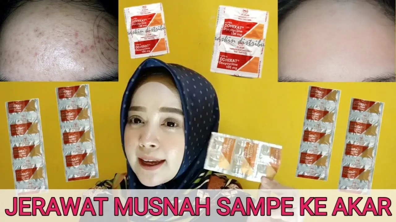 SALEP JERAWAT (APOTIK) YANG PALING AMPUH DAN CEPAT MENGHILANGKAN JERAWAT !. 