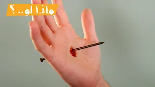 ماذا لو   فقدت الإحساس بالألم  دندنها
