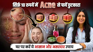 Easy and Simple Home Remedies to get Relief in Acne | Homemade Magical Facepack | Upasana Ki Duniya