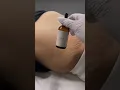 Stretch Marks Inkless Removal Boleyn Treatment Los Angeles