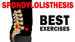 Best Spondylolisthesis Exercises for RELIEF (& what to avoid)