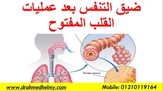 صعوبة أو ضيق النفس بعد عمليات القلب المفتوح 