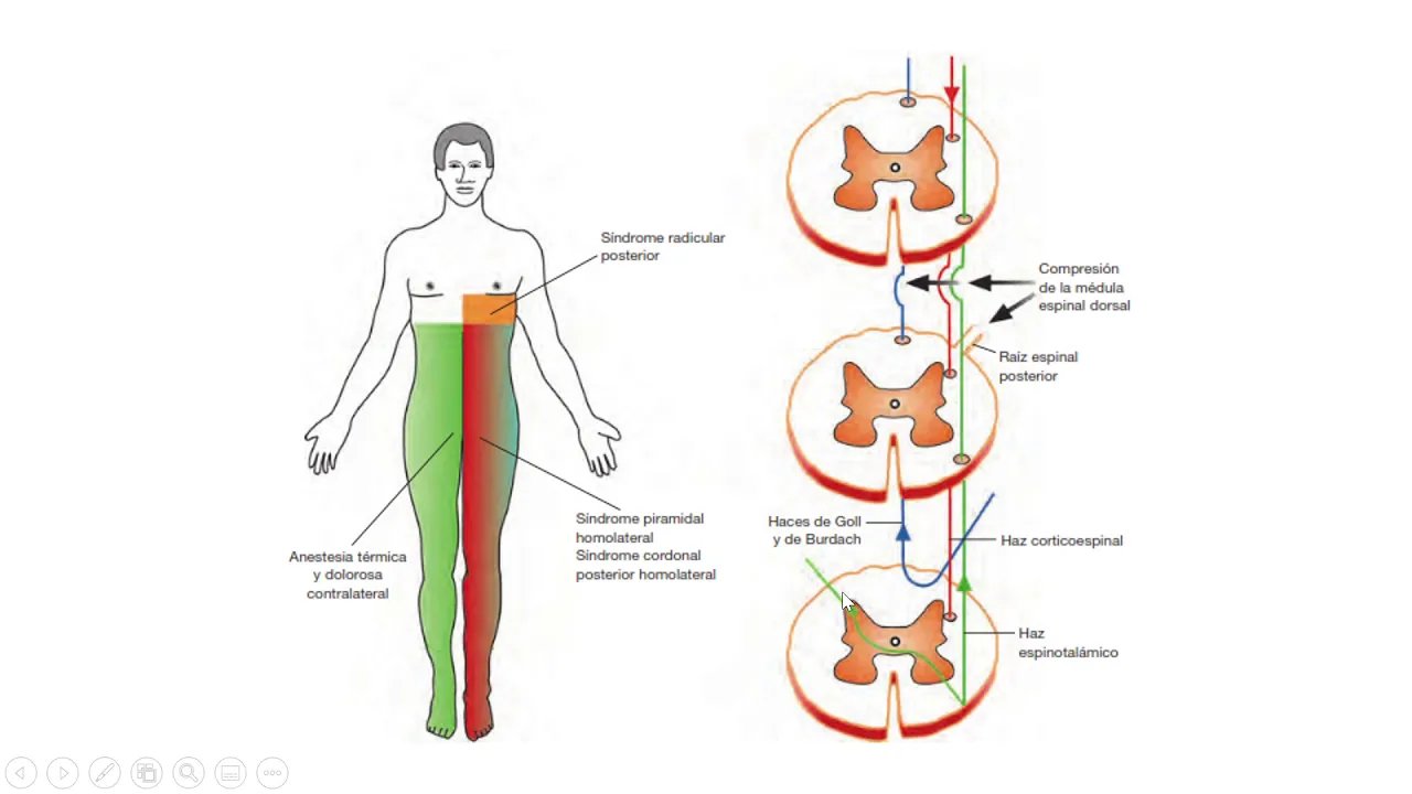Fisiopatología - Alteraciones de la vía motora principal y la vía sensitiva (Parte 2)