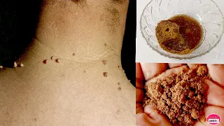 Download Remove Skin Tags Naturally with Masala /Home Remedies To Remove Skin Tags Easily with Masala MP3