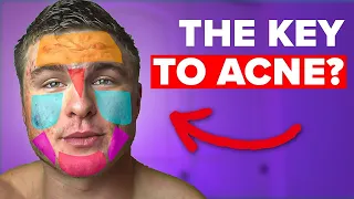 What Does Your Acne Mean By Location Face Maps