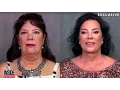 KRIS JENNER s Sister s AWAKE FACELIFT by the Best Facelift Plastic Surgeon in Beverly Hills