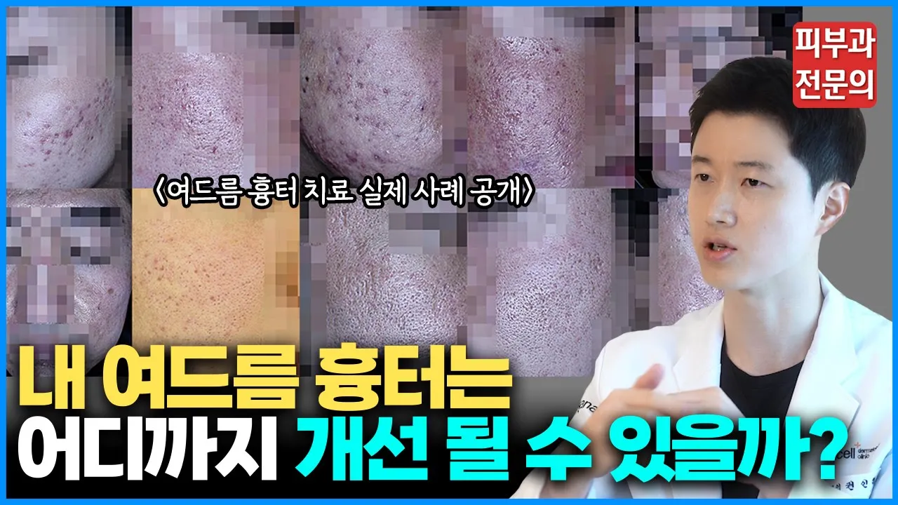 수많은 치료를 받아도 내 여드름 흉터가 낫지 않는 이유 / 여드름 흉터 치료의 본질을 알려드립니다