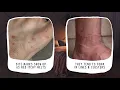 What Are The Signs And Symptoms Of Bed Bug Bites