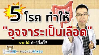 ลำไส้ใหญ่เป็นกระเปาะเป็นโรคอะไร และมีความเสี่ยงอย่างไร?