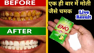 दांत सफेद करने का जादूई इलाज - डेंटिस्ट भी दे देंगे ताली|| #teethwhitening #desiilaj #teeth