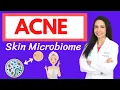 ACNE and the Skin Microbiome A Holistic Approach to Healing Your Acne from the Inside Out