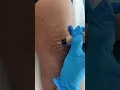 Stretch Marks Inkless Removal Boleyn Treatment Los Angeles