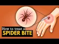 How to Treat A Spider s Bite