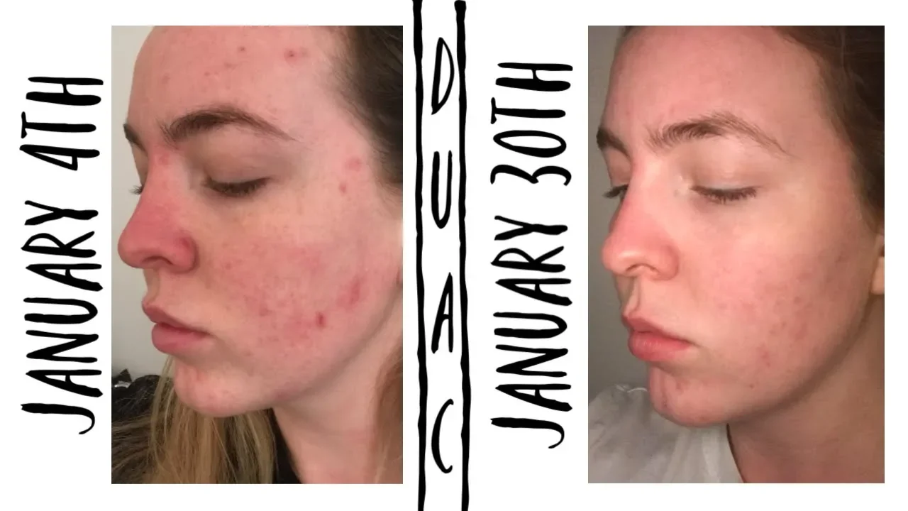 
          
          
          
            
            MY ACNE STORY AND HOW DUAC SAVED MY SKIN
          
        . 