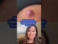 Download Lagu Dr Pimple Popper Reacts to Inflamed Cyst! #shorts #drpimplepopper
