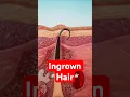 Ingrown Hair - Science Explained