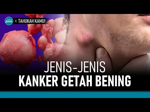 Beda Penanganan! Kenali Berbagai Jenis Kanker Getah Bening