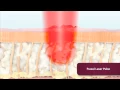 NEW LASER FRAXEL DUAL LONG ISLAND PERFECT BODY LASER