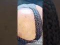Anyone with alopecia can get braid