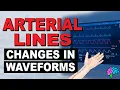 Common Changes in Arterial Line Waveforms