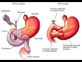 Pancreaticojejunostomy CPT codes - simplify medical coding