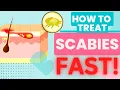 HOW TO TREAT SCABIES FAST TREATMENT AND HOME REMEDIES