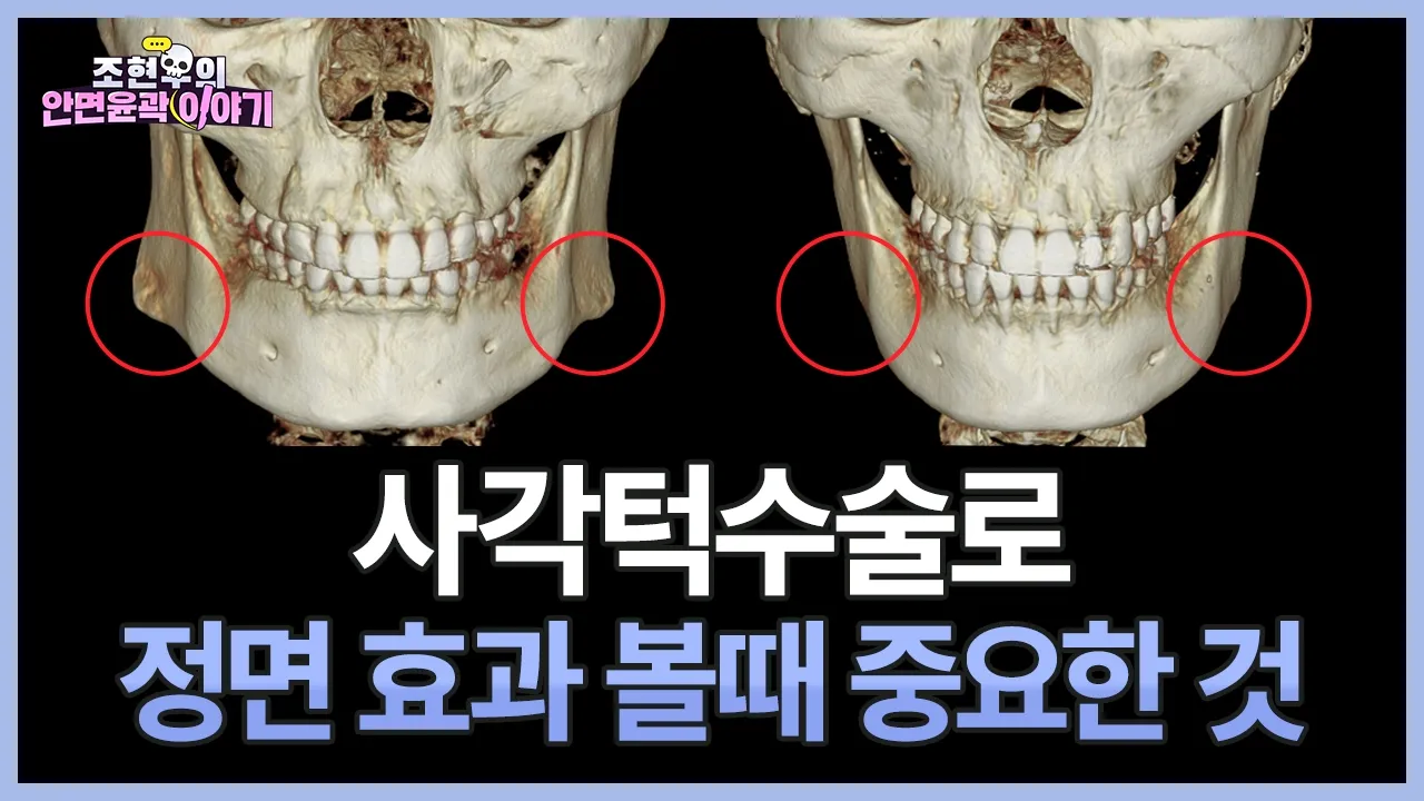 사각턱 유형별 정면에서 수술 효과 보는 법 │ 뻗친 턱뼈 vs 말린 턱뼈