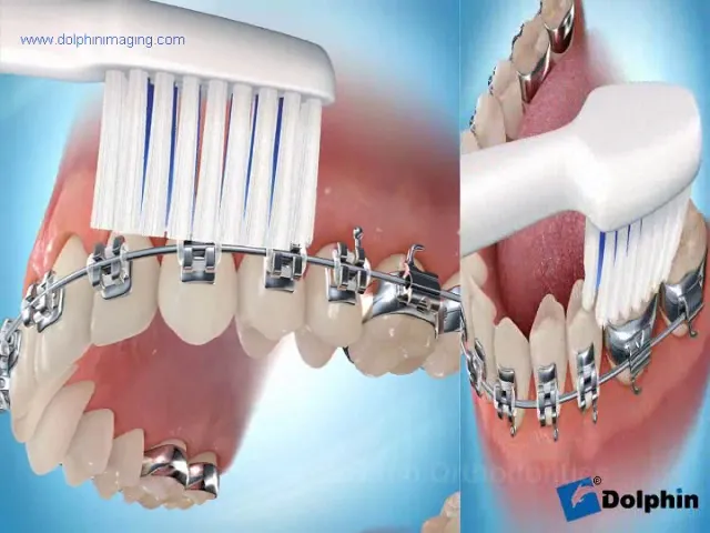 Brushing with Braces