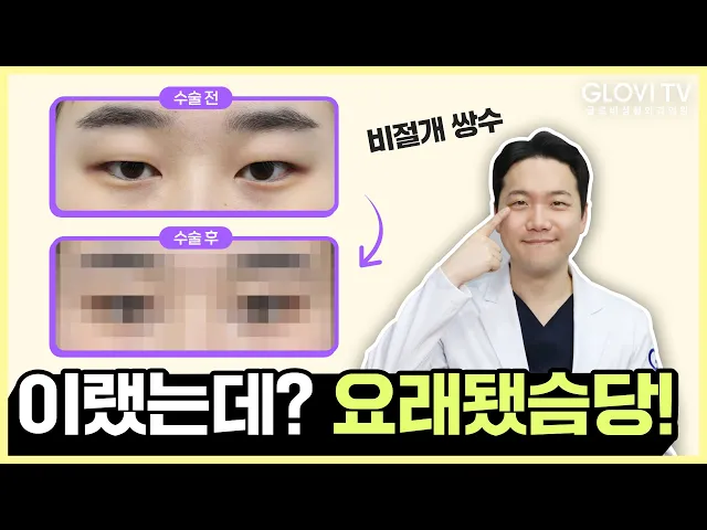 자연유착✨  눈 성형 리뷰📝